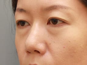 目の下のクマ・タルミ症例手術前