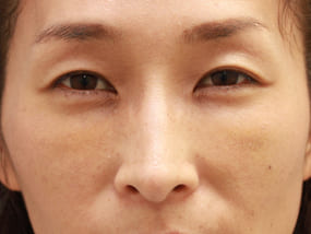 目の下のクマ・タルミ症例手術④脱脂＋脂肪注入後（メイクなし）