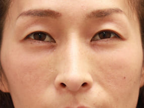 目の下のクマ・タルミ症例⑥手術１週間後（メイクあり）