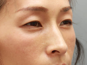 目の下のクマ・タルミ症例⑥-２手術１週間後（メイクあり）