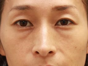 目の下のクマ・タルミ症例手術前