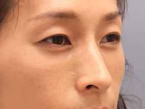 目の下のクマ・タルミ症例⑦-２手術２週間後（メイクあり）