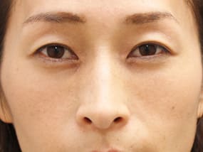 目の下のクマ・タルミ症例⑧手術１ヵ月後（メイクあり）