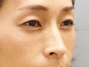 目の下のクマ・タルミ症例⑧-２手術１ヵ月後（メイクあり）