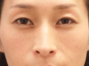 目の下のクマ・タルミ症例⑨手術２ヵ月後（メイクあり）