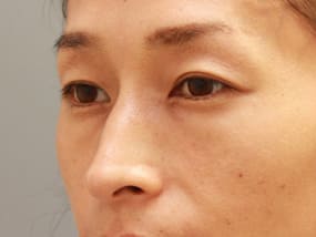 目の下のクマ・タルミ症例手術前