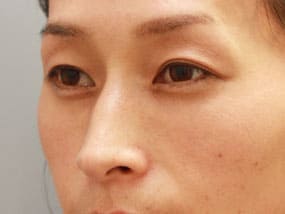 目の下のクマ・タルミ症例手術２ヵ月後