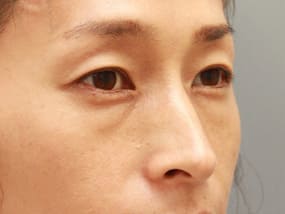 目の下のクマ・タルミ症例手術前
