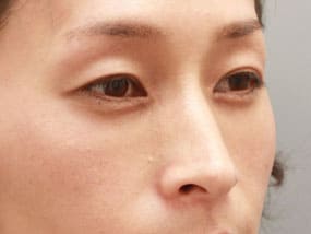 目の下のクマ・タルミ症例手術２ヵ月後
