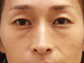 目の下のクマ・タルミ症例①手術前（メイクあり）