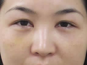 目の下のクマ・タルミ症例手術１週間後（メイクあり）