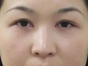 目の下のクマ・タルミ症例手術１ヵ月後（メイクあり）