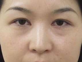 目の下のクマ・タルミ症例手術前