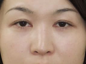 目の下のクマ・タルミ症例手術３ヶ月後