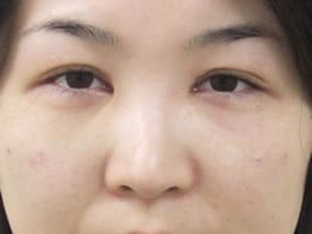 目の下のクマ・タルミ症例手術前