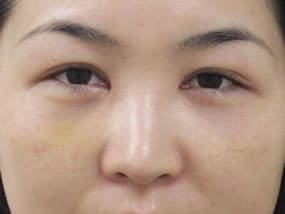 目の下のクマ・タルミ症例手術３ヶ月後