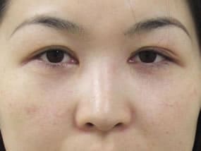 目の下のクマ・タルミ症例手術前