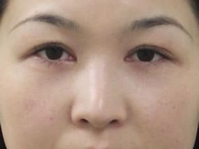 目の下のクマ・タルミ症例手術３ヶ月後