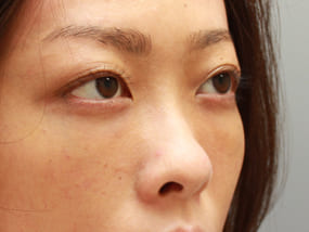目の下のクマ・タルミ症例⑥-２手術１週間後（メイクあり）