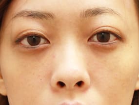 目の下のクマ・タルミ症例⑨手術２ヵ月後（メイクあり）