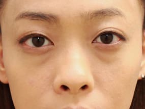 目の下のクマ・タルミ症例手術前