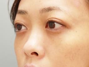 目の下のクマ・タルミ症例手術２ヵ月後