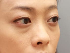 目の下のクマ・タルミ症例手術前