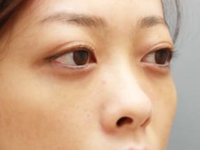 目の下のクマ・タルミ症例手術２ヵ月後