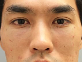 目の下のクマ・タルミ症例手術③手術直後