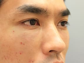 目の下のクマ・タルミ症例手術③-２手術直後