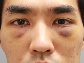 目の下のクマ・タルミ症例手術④手術３日後