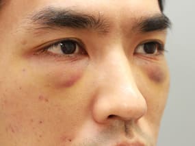目の下のクマ・タルミ症例手術④-２手術３日後