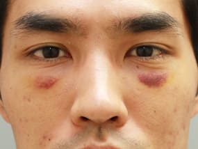 目の下のクマ・タルミ症例⑤手術１週間後