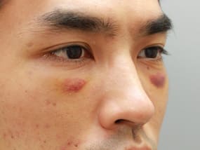 目の下のクマ・タルミ症例⑤-２手術１週間後