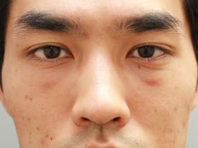 目の下のクマ・タルミ症例⑥手術２週間後