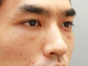 目の下のクマ・タルミ症例⑥-２手術２週間後
