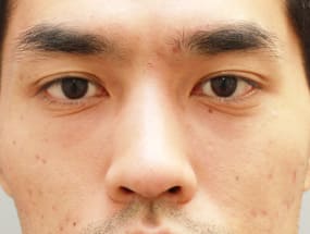 目の下のクマ・タルミ症例⑦手術１ヵ月