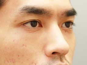 目の下のクマ・タルミ症例⑦-２手術１ヵ月