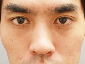 目の下のクマ・タルミ症例⑧手術２ヵ月後