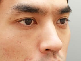 目の下のクマ・タルミ症例⑧-２手術２ヵ月後