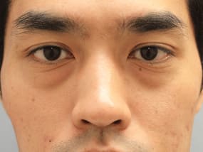 目の下のクマ・タルミ症例①手術前