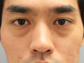 目の下のクマ・タルミ症例手術前