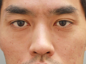 目の下のクマ・タルミ症例手術３ヶ月後