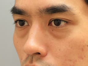 目の下のクマ・タルミ症例手術前