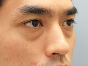 目の下のクマ・タルミ症例手術前