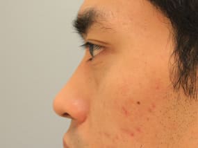 目の下のクマ・タルミ症例手術前