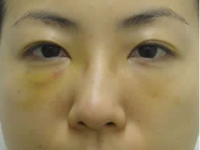 目の下のクマ・タルミ症例手術直後（メイクなし）