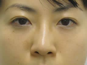 目の下のクマ・タルミ症例手術２週間後（メイクあり）
