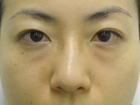 目の下のクマ・タルミ症例手術前
