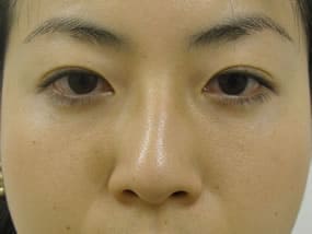 目の下のクマ・タルミ症例手術３ヶ月後